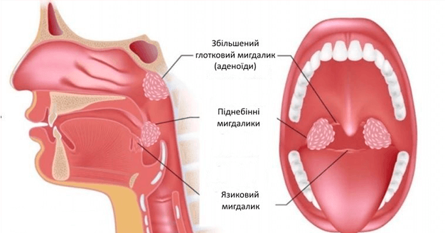 Лікування ангіни в Києві – клініка Дубровського