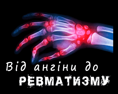 Лікування ангіни – клініка лікаря Дубровського