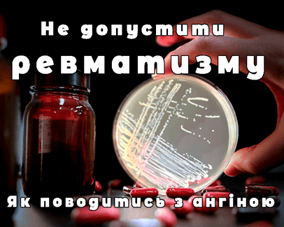 Лікування ангіни в Києві - клініка Дубровського